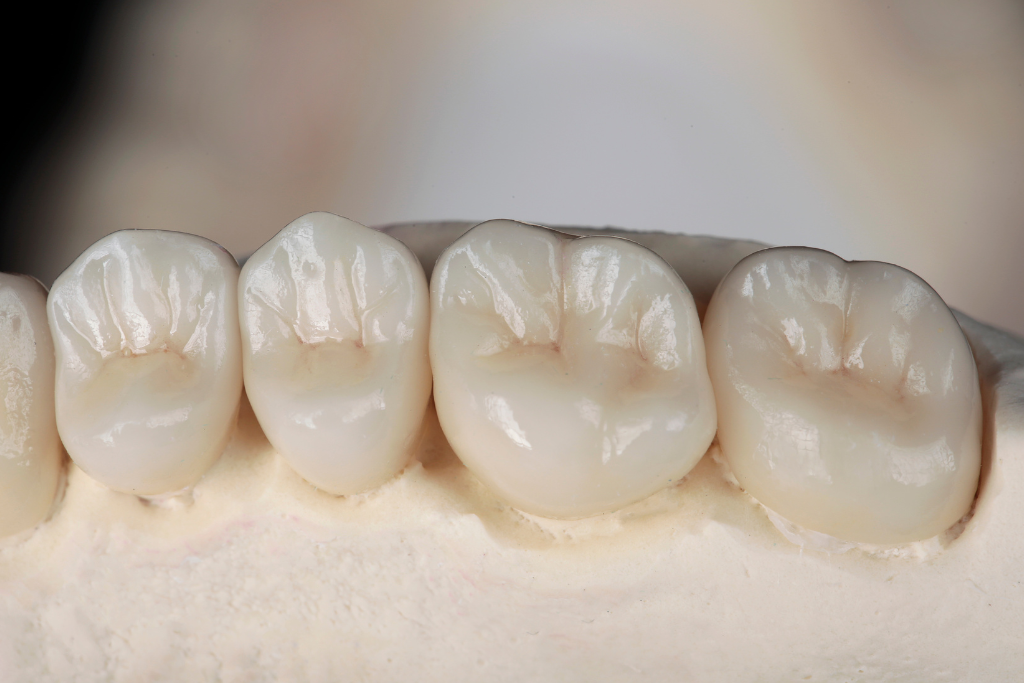 治療開始とセラミックの装着