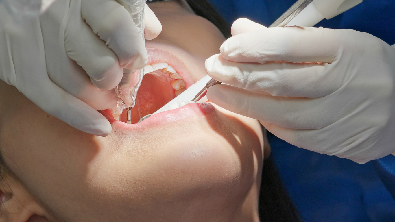 スケーリング(歯石除去)