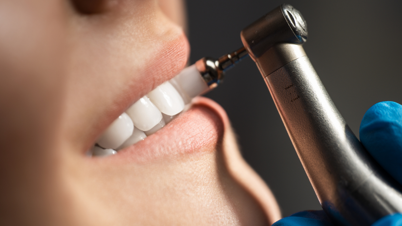 PMTC(専門的な歯面清掃)