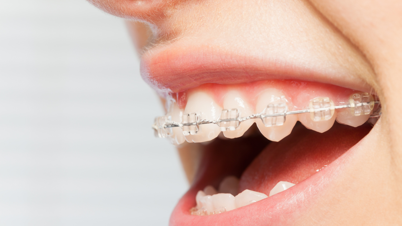 矯正装置の装着