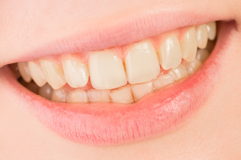 歯の黄ばみが気になる方へ